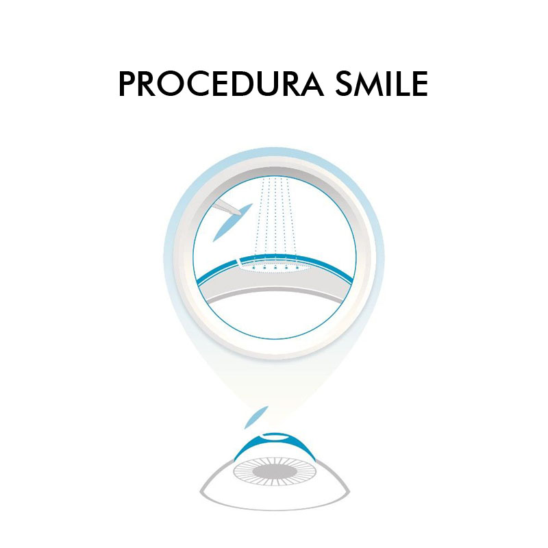 SMILE-PROCEDURA-1