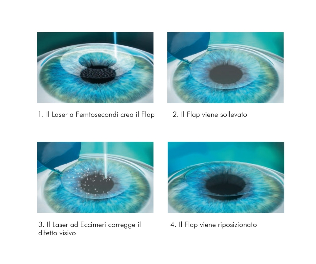 lasik_grafica